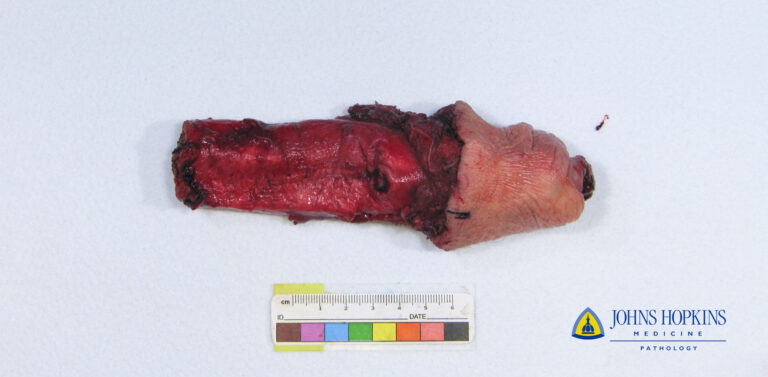 Invasive Squamous Cell Carcinoma Surgical Pathology Photo Website