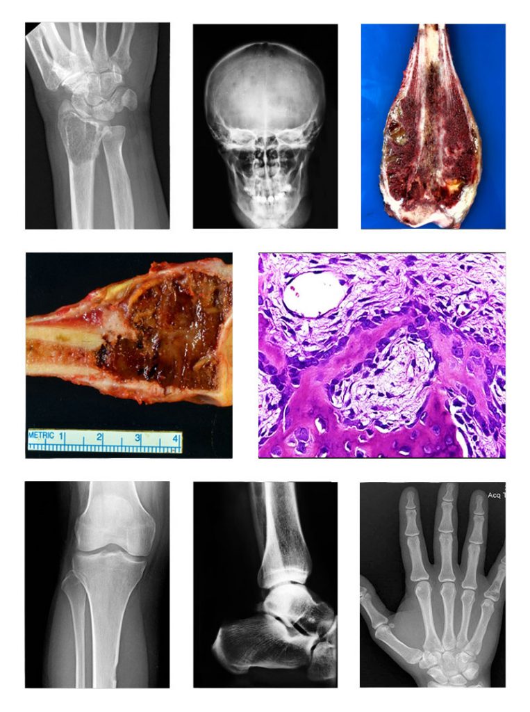 Bone Biopsy  Johns Hopkins Medicine