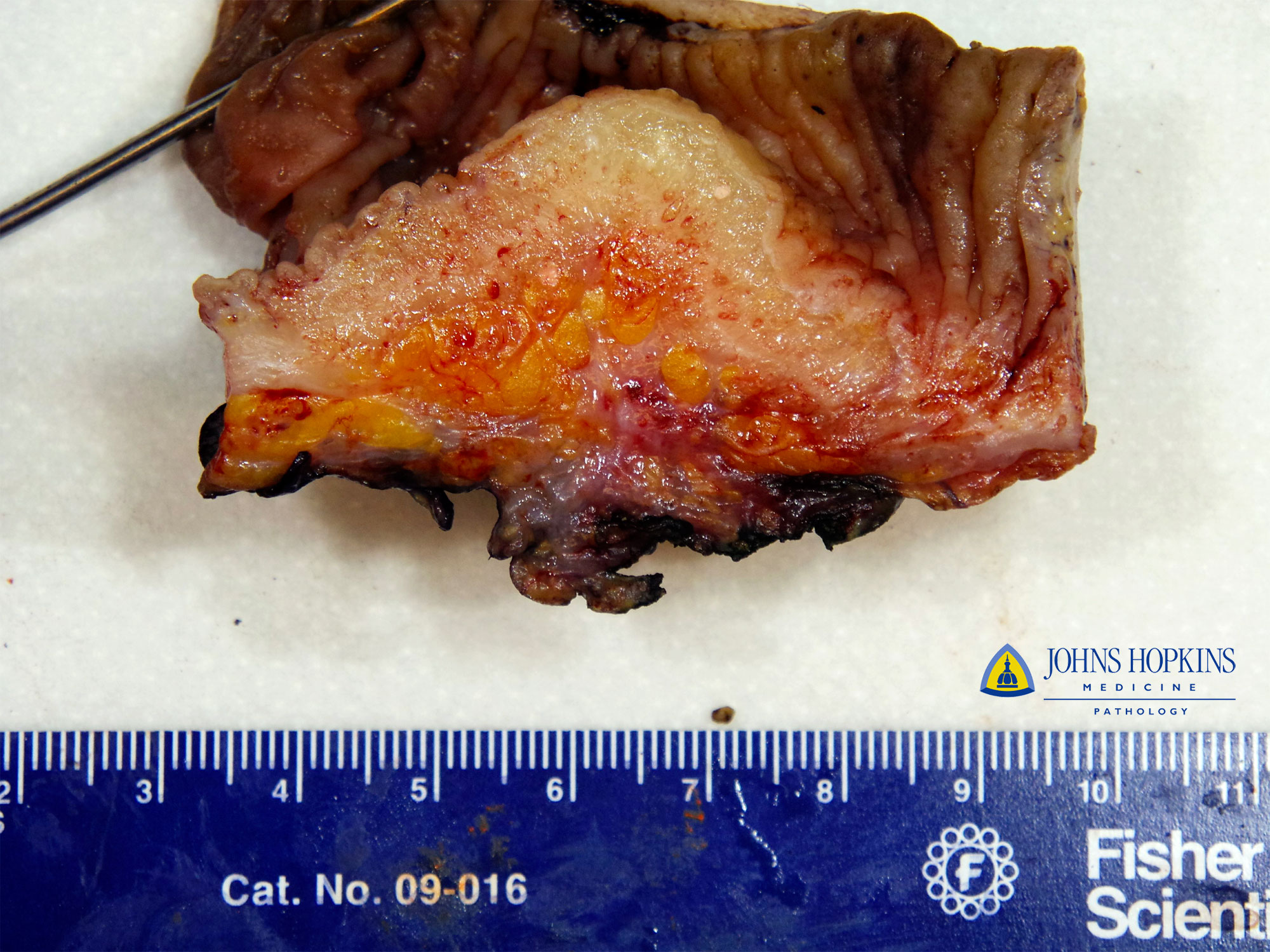 PDF] Signet Ring Carcinoma of the Appendix- A Rare Case Report | Semantic  Scholar